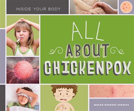 Cover image for All About Chickenpox