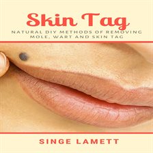 Imagen de portada para Skin Tag: Natural DIY Methods of removing Mole, Wart and Skin Tag