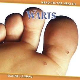 Cover image for Warts