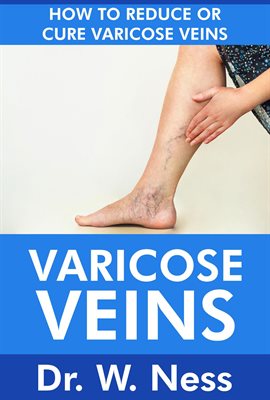 Cover image for Varicose Veins: How To Reduce Or Cure Varicose Veins