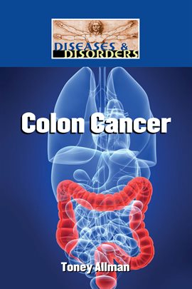 Cover image for Colon Cancer