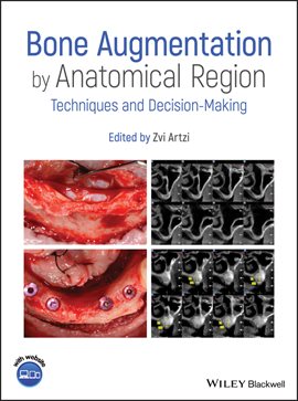 Cover image for Bone Augmentation by Anatomical Region